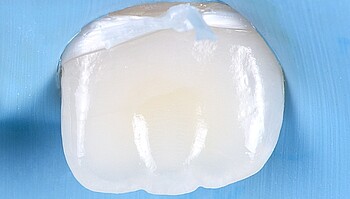 Glanzende, bewerkte tand zonder white spots